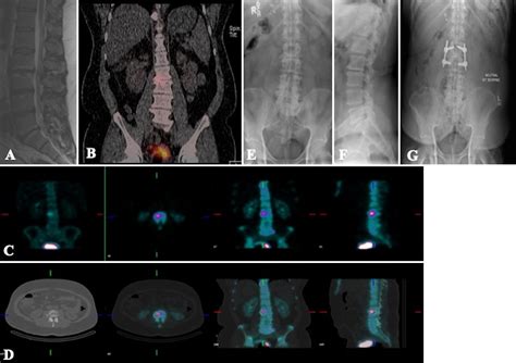 Preoperative Spect Imaging As A Tool For Surgical Planning In Patients