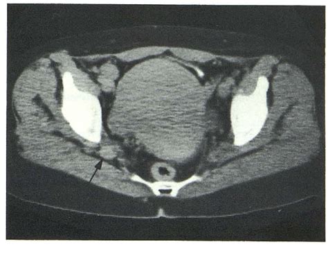 [PDF] CT evaluation of the greater sciatic foramen in patients with sciatica. | Semantic Scholar