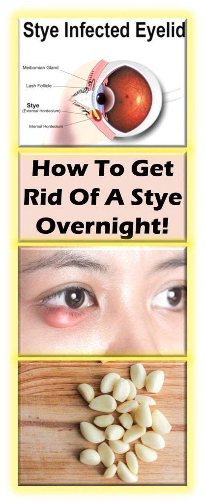 How To Get Rid Of A Stye Overnight Natural Health Tips Remedies Natural Health Remedies