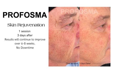 PROFOSMA Jet Plasma SkinRX Aesthetic Clinic PTY LTD