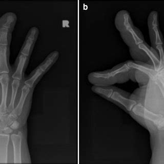 Right Hand Plain Radiographs A Anteroposterior And B Lateral Views