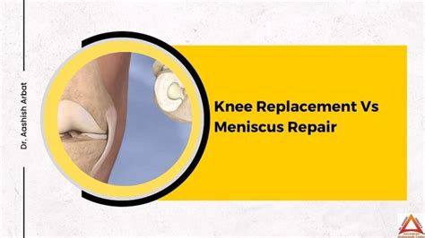 Knee Replacement Vs Meniscus Repair