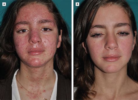 Demodex-Associated Oculocutaneous Rosacea | Adolescent Medicine | JAMA ...