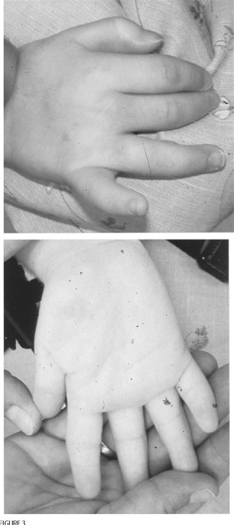 Figure From Further Delineation Of Deletion P Syndrome In