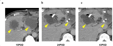Several Time Drainage For Multiple Liver Abscesses After Operation