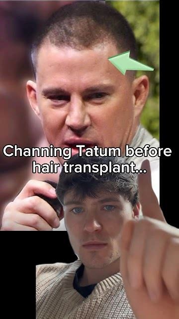 Channing Tatum Hair Transplant ⚠️ Shorts Hairtransplant Youtube