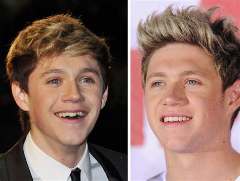 Niall Horan Before And After Braces And Dental Work Celebrity Teeth