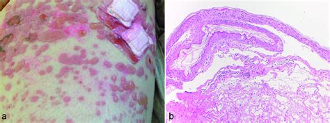 Clinical And Histological Manifestations Of Linear IgA Bullous Disease