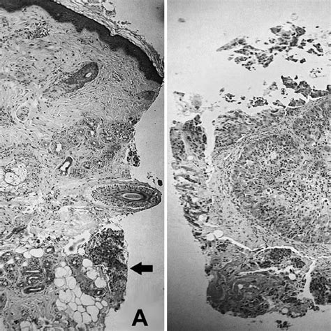 Computed Tomography Scan Reveals Expansile Osteolytic Calvarial Lesion Download Scientific