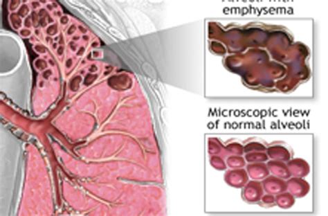 Pulmonary Vein Disease (Lung Disease)