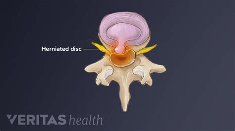diagnosing  lumbar herniated disc spine health