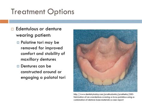 What Is Palatal Tori at Elsy Martin blog