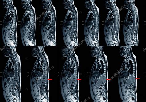 Recopilaci N De Rm De Columna Vertebral Completa Plano Sagital T W Para