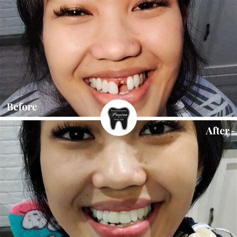 Gigi Tiruan Permanen Harga Pasang Passion Dental Care