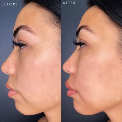 Las Vegas Aesthetic Facial Fillers Sculpt Spa