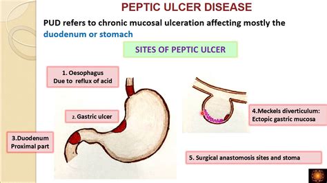 Peptic ulcer disease - Dr.V.Shanthi - YouTube