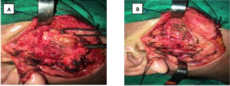 Figure 1 From Küttner S Tumor With Parotid Gland Involvement Semantic