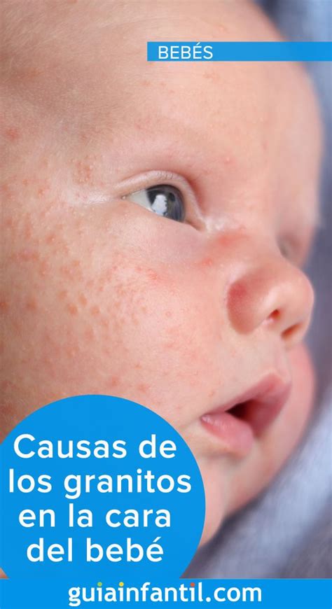 Causas de los granitos en la cara del bebé Granitos en la cara Bebe