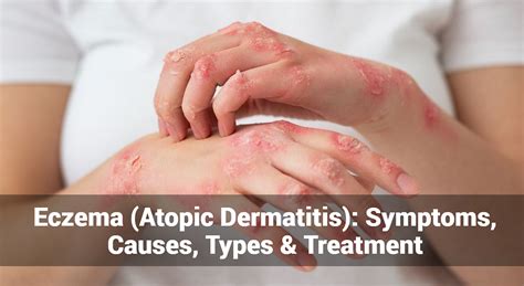 Eczema Atopic Dermatitis Understanding Symptoms Causes Types And