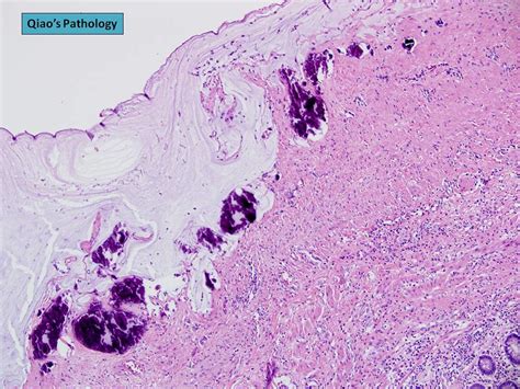 Qiaos Pathology Appendiceal Mucinous Neoplasm With Low R… Flickr