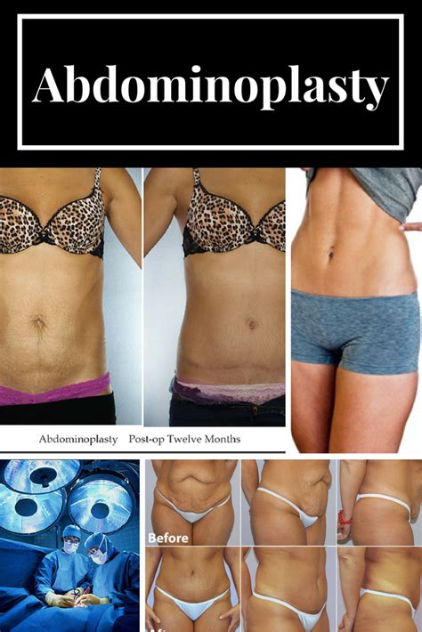 Rochester Abdominoplasty Surgery Ny Tummy Tuck Surgeon