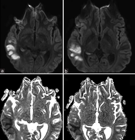 A And B Axial DWI Trace Images And C And D Corresponding ADC