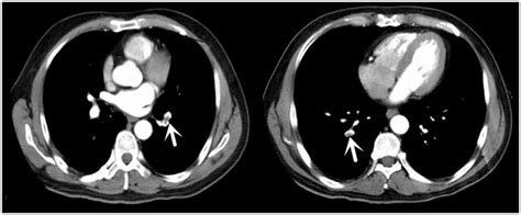 Computed tomographic pulmonary angiography images of a 58-year-old male ...