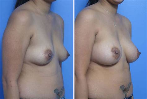 Breast Augmentation Case 16 Anthony Youn MD FACS