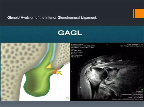 Shoulder labral tears MRI | PPTX