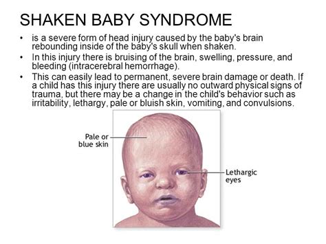 Signs of head injury in baby