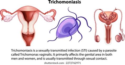 Trichomoniasis Infographic Explanation Illustration Stock Vector Royalty Free 2272762971