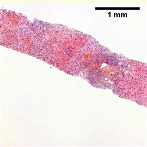 Primary Biliary Cirrhosis Libre Pathology