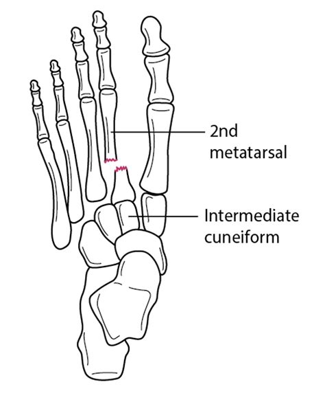 Image Fracture Of The 2nd Metatarsal Base With Tarsometatarsal Joint Dislocation Merck Manual