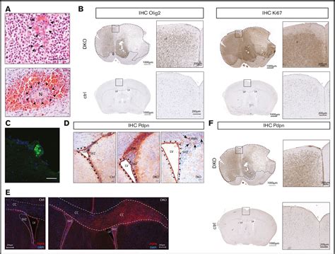 Figure From Intratumoral Platelet Aggregate Formation In A Murine