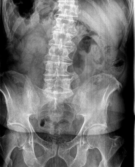 Film X Ray Or Radiograph Of An Adult Lumbar Vertebrae Anterior