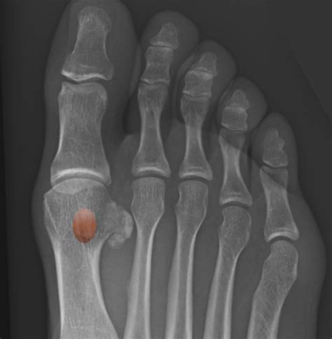 Sesamoid Bone Fracture