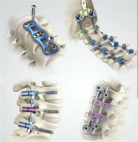 Spinal Implants Market Size Share Trends Opportunities