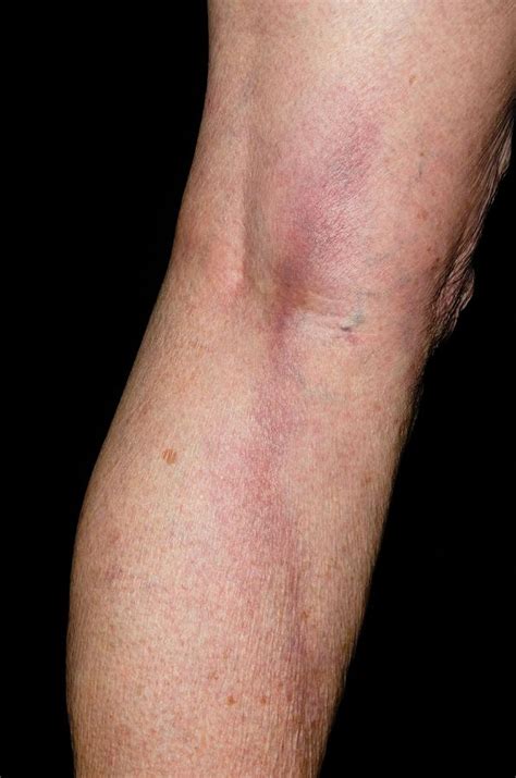 Thrombophlebitis In The Leg Photograph By Dr P Marazzi Science Photo