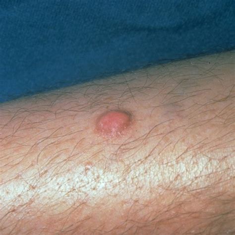 Raised Skin Bumps Pictures Symptoms Causes Treatments