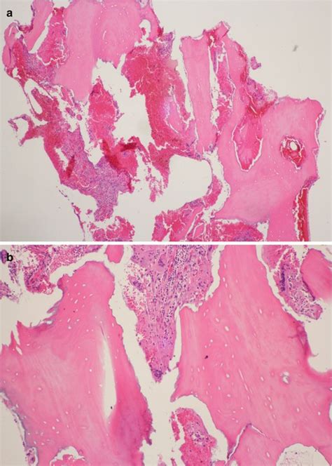 Osteoradionecrosis Histology