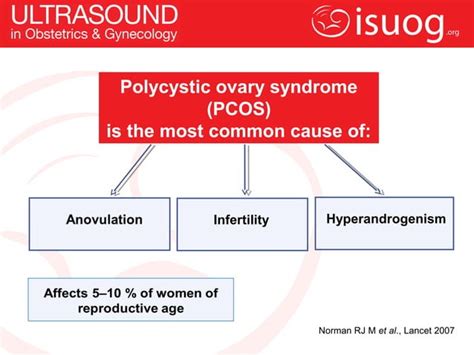 Uog Journal Club Polycystic Ovaries At Ultrasound Normal Variant Or