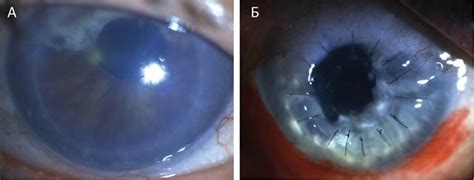 Penetrating Keratoplasty Was Performed In Patient N With Pkg For 1 Download Scientific Diagram