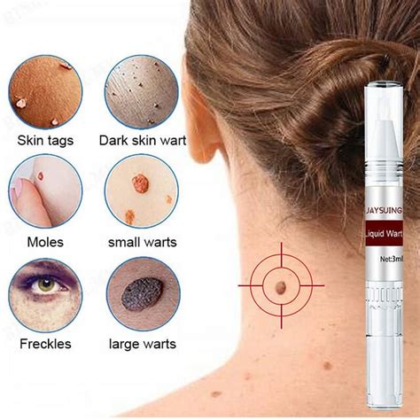 Best Deals For Jaysuing Wart Removal Liquid Pen Skin Tag Removal Liquid