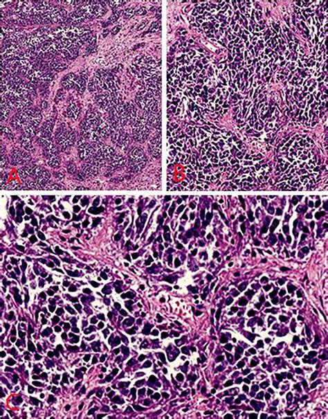 A Lymphoepithelioma Like Carcinomas Staining H Magnification