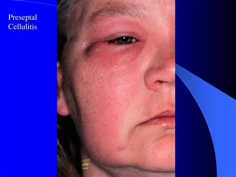 Ppt Periorbital Cellulitis Powerpoint Presentation Free Download