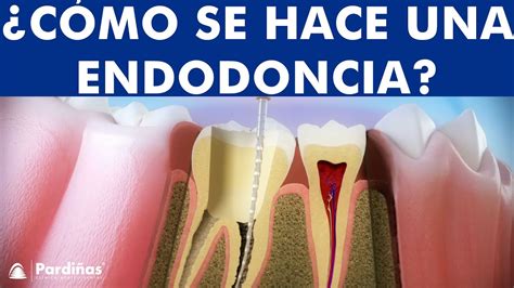 ¿qué Es Una Endodoncia Tratamiento De Conductos O Desvitalización