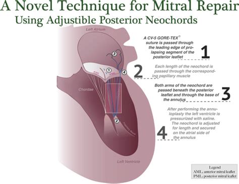 Mitral Valve Posterior Leaflet