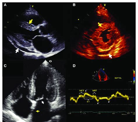 Characteristic appearance of cardiac amyloidosis on echocardiography ...