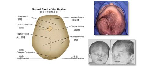 婴儿颅骨畸形基本知识