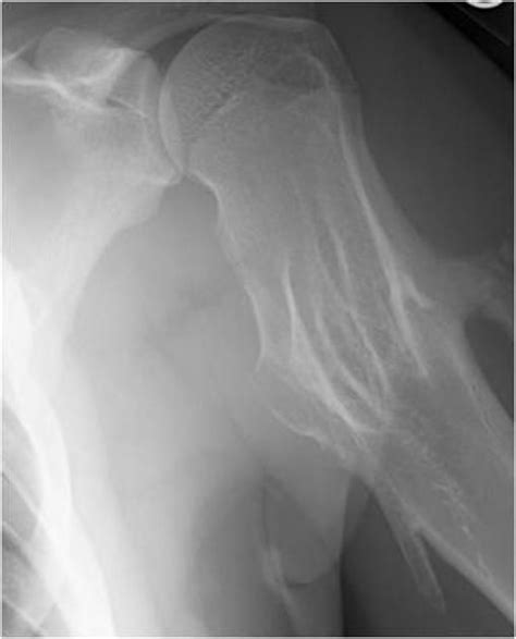 Understanding Hereditary Multiple Exostoses